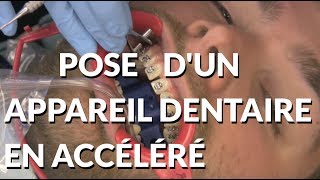 Pose dun appareil en accéléré  Appareildentaireinfo [upl. by Connell654]