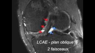 Ligament croise anterieur  normal  IRM 3D [upl. by Ainirtac]