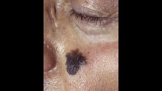 Squamous Cell Carcinoma and Lentigo Maligna Melanoma plus the precancerous conditions [upl. by Aiderfla]