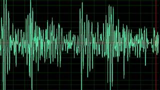 Aortic Regurgitation slow [upl. by Hobbs]