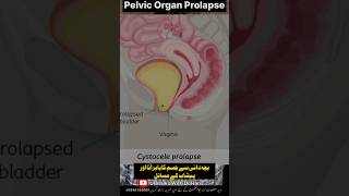 Vaginal Prolapse  Cystocele  Bachadani se Josm ka Baher aana shorts shortsvideo shortsfeed [upl. by Suoilenroc]