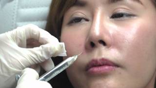 Juvederm Fillers [upl. by Nakre]