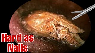 Unbelievable mass of mans Earwax  Earwax removal  Doctor Anh [upl. by Drusy]