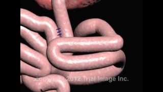 Intussusception of the Bowel video  Animation by Cal Shipley MD [upl. by Eirrol]