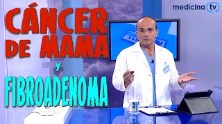 CÁNCER DE MAMA y FIBROADENOMA ¿Alguna relación ¿Aumenta el Riesgo  CÁNCER 28 [upl. by Arev]