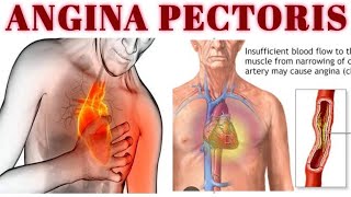 ANGINA PECTORIS  DEFINITION  TYPES  CAUSE  PATHOPHYSIOLOGY  SYMPTOMS  TREATMENT [upl. by Yhotmit]