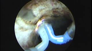 Transurethral plasma vaporization of the prostate TURIS TUVIS [upl. by Niknar]