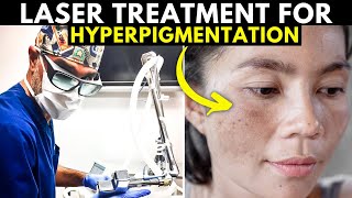 Do Lasers ACTUALLY WORK for Sun Spots Age Spots and Hyperpigmentation [upl. by Ardied]