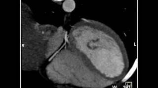 Cardiac Right Coronary Artery 4 of 7 [upl. by Tilla]