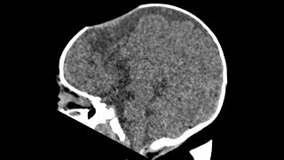 Sanken fontanelle  paediatric neuro case  CT findings [upl. by Harvard40]