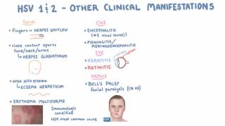 HSV  Clinical Presentation  Part 2 [upl. by Helm20]