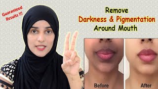 How to Remove Dark Upper Lips  Black patches Dark Spots Hyper pigmentation around Mouth [upl. by Oinotna]