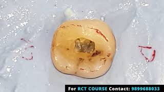 Endo Access Preparation  Mandibular First Molar Live Demo General Dentistry Course Root Canal [upl. by Ecaidnac]