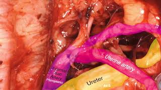 Laparoscopic Review of Internal Iliac Artery [upl. by Mctyre190]