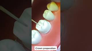 Crown Preparation dentalstudents [upl. by Kirby972]