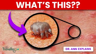 Scabies  WARNING Doctor explains Causes Symptoms and Treatments [upl. by Nuzzi595]