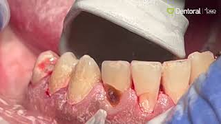 AquaCare Caries Removal [upl. by Yboj962]