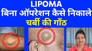 चर्बी की गाँठ  LIPOMA  को बिना ऑपरेशन कैसे निकाले । LIPOMA homeopathic treatment [upl. by Bertolde3]