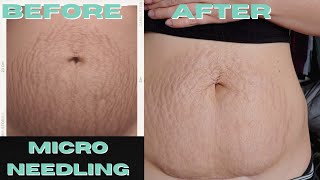 I Got Professional Microneedling Done on my Stretch Marks Results and What to Expect [upl. by Natka829]