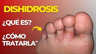 🚨 ¿DISHIDROSIS EN PODOLOGIA ¿Qué es y ¿Cómo TRATARLA👀 [upl. by Ger]