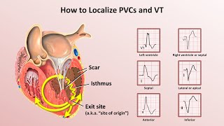 Advanced EKGs  Ventricular Tachycardia Classification amp Localization [upl. by Nilo765]