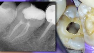 LIVE Molar Root Canal w Merging Canals  Occlusal Caries Molar Access [upl. by Zischke989]