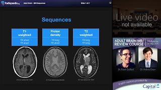 Stroke Hypertensive haemorrhage  radiology video tutorial MRI CT [upl. by Ammej826]