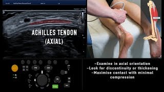 Ultrasound Tutorial MSK Series Achilles Tendon  Radiology Nation [upl. by Ellehsim]