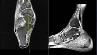 Posterior tibial tendon tear and magic angle phenomenon [upl. by Ana]