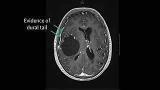 Grade 1 Meningioma [upl. by Finegan]