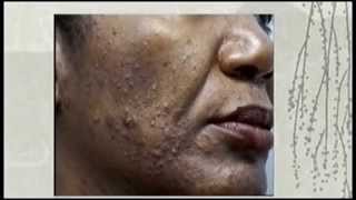 Lamprobe gets rid of skin irregularities  Pittsburgh Pa [upl. by Navillus671]