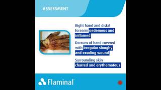 Case Report  Flaminal® Forte in the recovery from Severe Burns [upl. by Averat989]