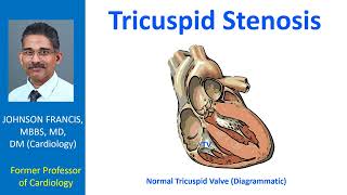 Tricuspid Stenosis [upl. by Ziza]