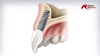 Angulated Screw Channel ASC Abutment [upl. by Anidnamra813]