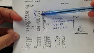 Hematology How to interpret automated Complete Blood Count CBC results [upl. by Ahsielat]