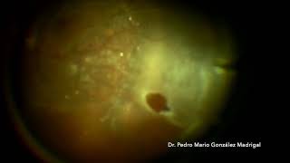 Vitrectomy for Rhegmatogenous Retinal detachment with PVR [upl. by Ericksen]