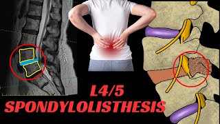 Spondylolisthesis [upl. by Allenod55]