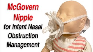 McGovern Nipple to Manage Infant Nasal Obstruction [upl. by Terb236]