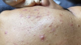 Blackheads amp Whiteheads Removal New 2024  Acne Treatment With Bo Nguyễn Spa 025 [upl. by Burnside]