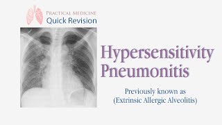 Hypersensitivity Pneumonitis Extrinsic Allergic Alveolitis  EAA [upl. by Evanthe]