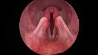 Dog Lar Par Laryngeal paralysis observed in sedated canine oral exam [upl. by Eigram]