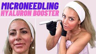 MICRONEEDLING nach Fruchtsäurepeeling  Mesotheraphie Vorbereitung [upl. by Lienahs]