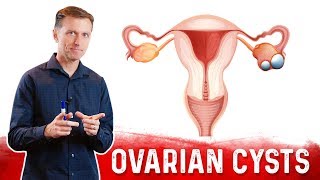 Ovarian Cysts Causes Symptoms amp Natural Treatment – DrBerg [upl. by Tristram]