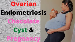 ओवरी सिस्ट के बाद क्या में माँ बन सकती हुEndometriosis amp Pregnancy Ovarian Chocolate Cyst shivayu [upl. by Retsevlis]