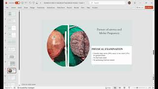 Hydatiform mole or Gestational Trophoblastic Disease [upl. by Letnoj]