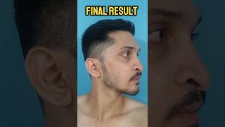 Jaw Surgery Before After Final beforeandafter jaw surgeryrecovery shortsfeed shorts facial [upl. by Ehtyaf]