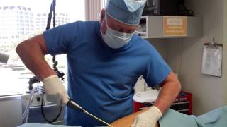 Dr Thomas Barnes LAUGHING THIGHS Tickle Lipo  Part I Newport Beach Ornage County [upl. by Anihsat]