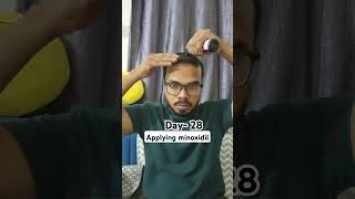 Day 28 Hair Regrowth journey Applying minoxidil bald minoxidil minoxidilresult hairloss [upl. by Blayze]