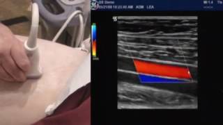 How To Lower Extremity Arterial Duplex Exam [upl. by Aicercal]