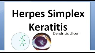 Ophthalmology 116 Herpes Simplex Keratitis Virus Cornea Dendritic HSV Wessley NeuroTrophic Disciform [upl. by Anicart436]